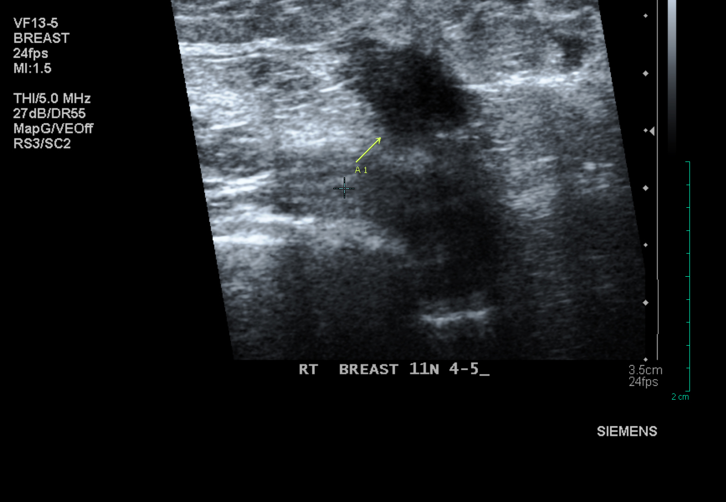 klomp misschien niet gevonden op echografie of mammogram